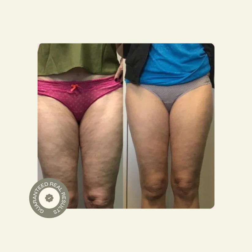 Luuma Pro Cellulite Roller