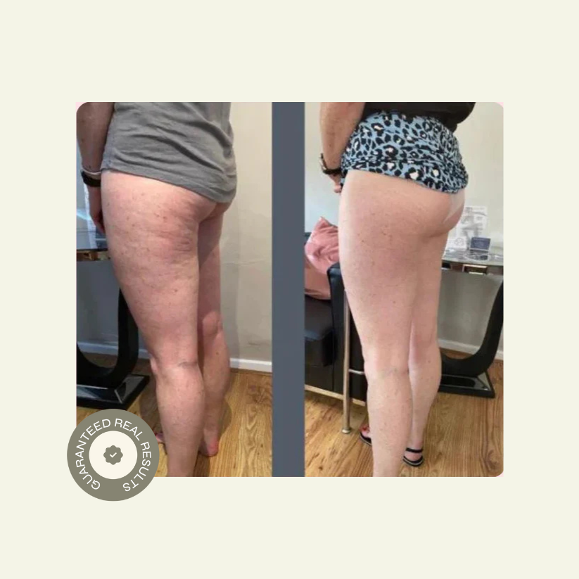 Luuma Pro Cellulite Roller