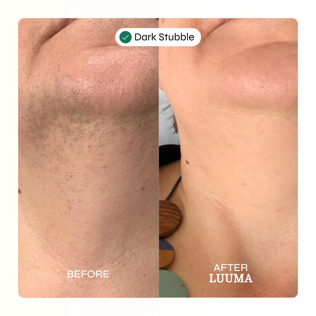 Facial Hair Removal Cream